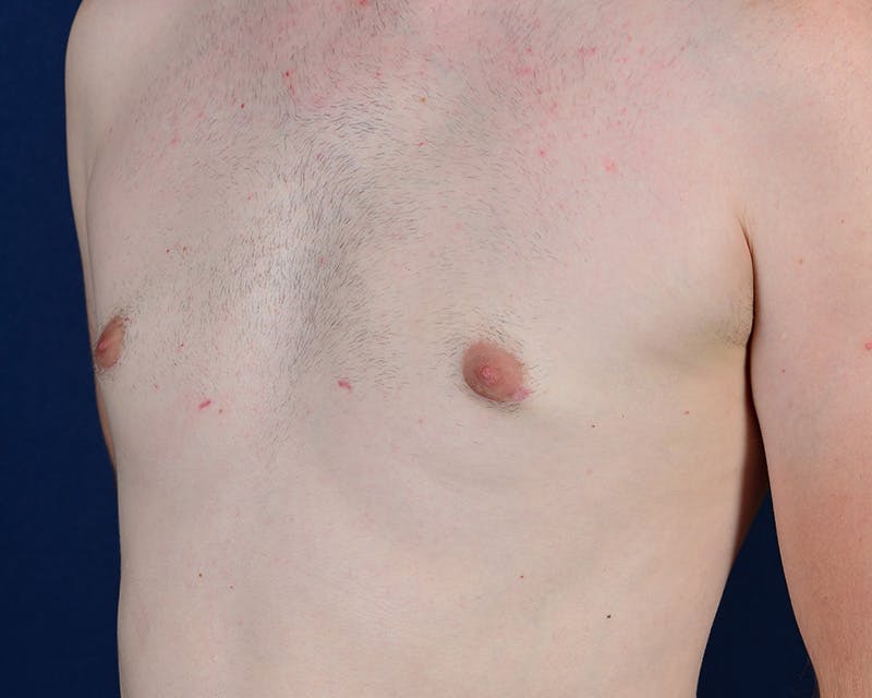 Gynecomastia Before & After Gallery - Patient 9712328 - Image 4