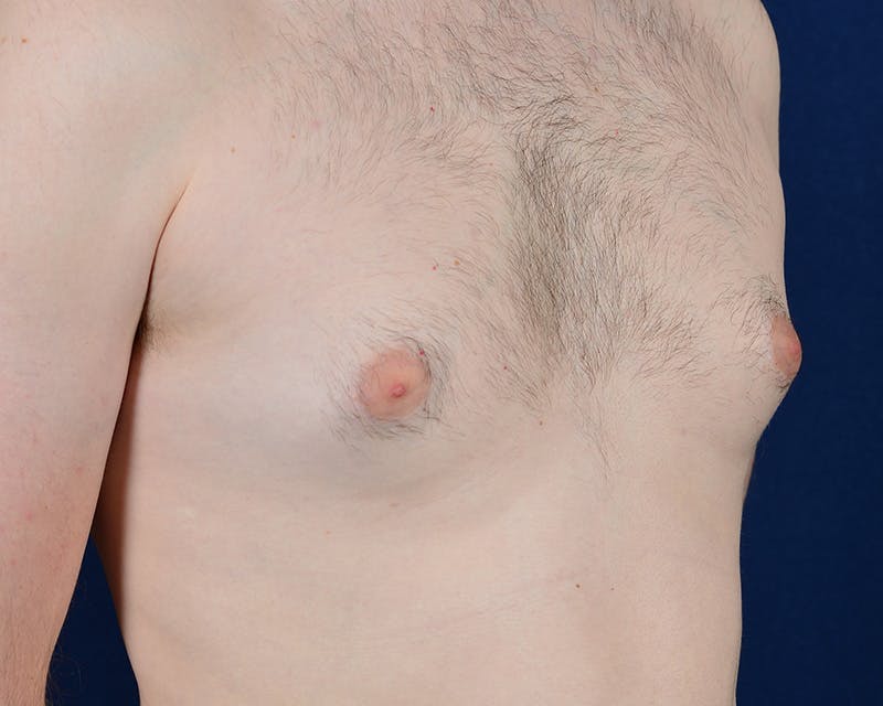 Gynecomastia Before & After Gallery - Patient 9712328 - Image 5
