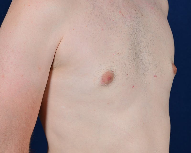 Gynecomastia Before & After Gallery - Patient 9712328 - Image 6