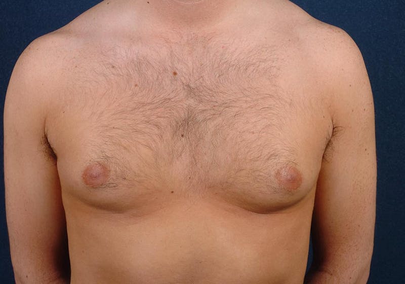 Gynecomastia Before & After Gallery - Patient 9712330 - Image 1