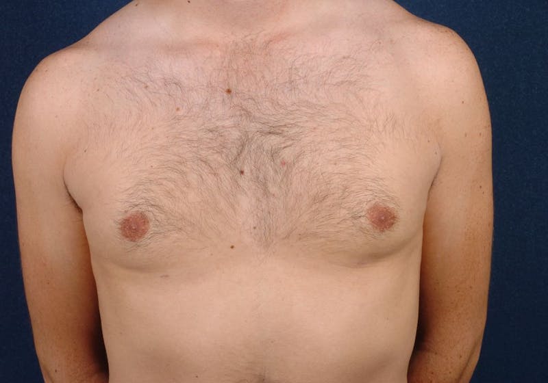 Gynecomastia Before & After Gallery - Patient 9712330 - Image 2