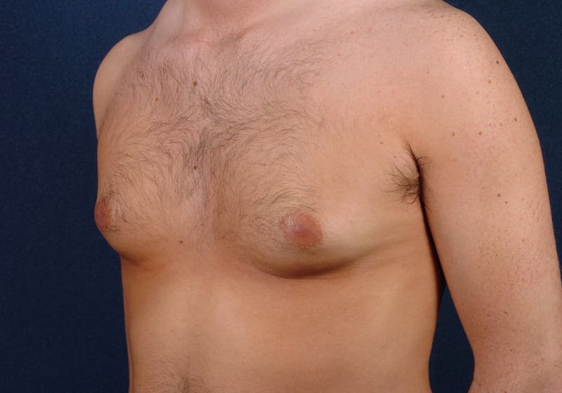 Gynecomastia Before & After Gallery - Patient 9712330 - Image 3