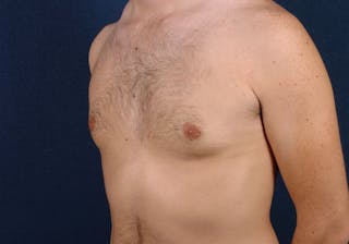 Gynecomastia Before & After Gallery - Patient 9712330 - Image 4