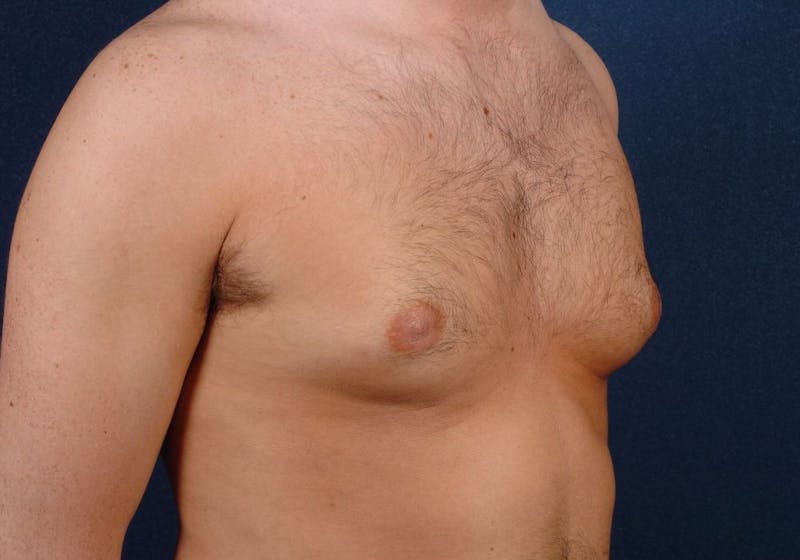 Gynecomastia Before & After Gallery - Patient 9712330 - Image 5