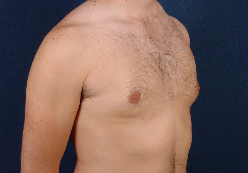 Gynecomastia Before & After Gallery - Patient 9712330 - Image 6