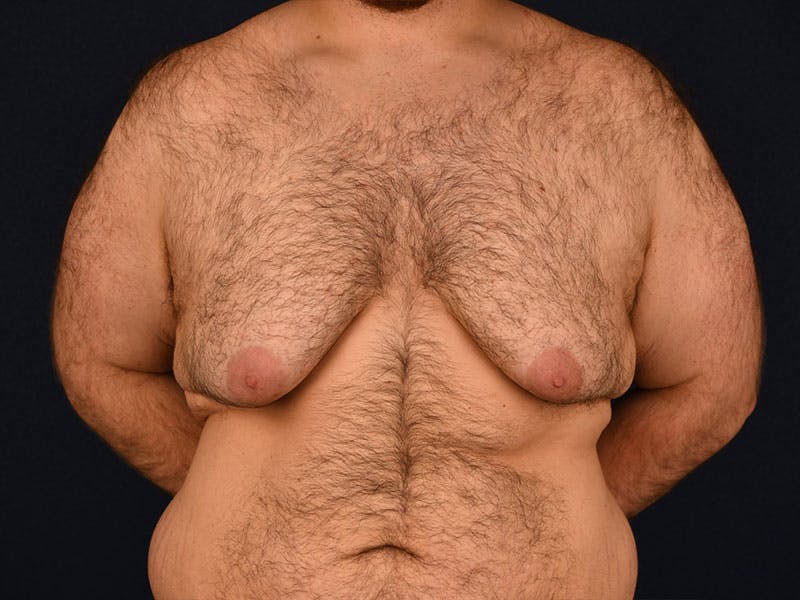 Gynecomastia Before & After Gallery - Patient 9712331 - Image 1