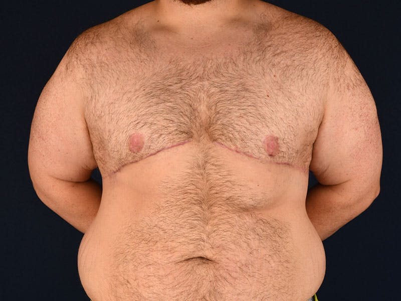 Gynecomastia Before & After Gallery - Patient 9712331 - Image 2