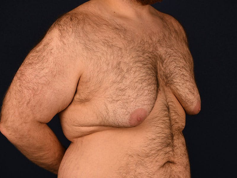 Gynecomastia Before & After Gallery - Patient 9712331 - Image 3