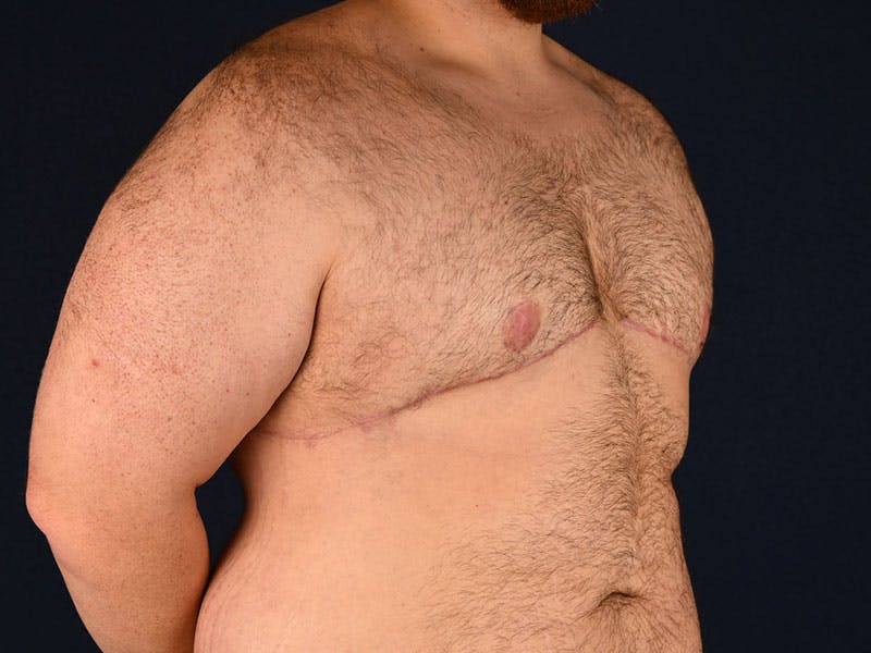 Gynecomastia Before & After Gallery - Patient 9712331 - Image 4
