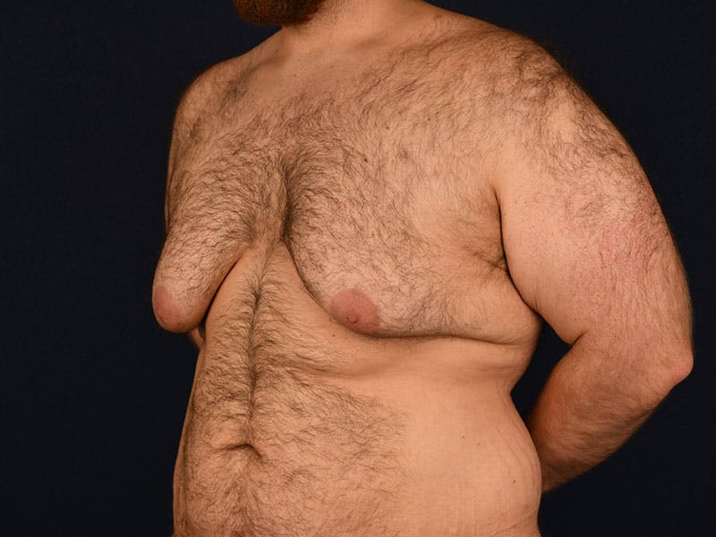 Gynecomastia Before & After Gallery - Patient 9712331 - Image 5