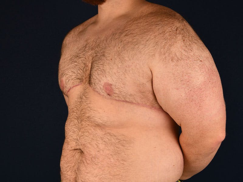 Gynecomastia Before & After Gallery - Patient 9712331 - Image 6