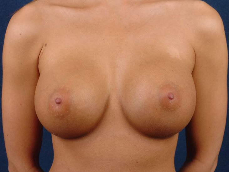 Large Breast Implants