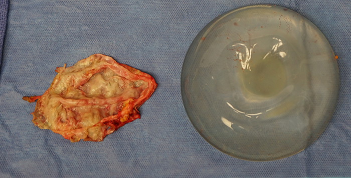 Calcified Capsule - Capsule Contracture - Breast Implants