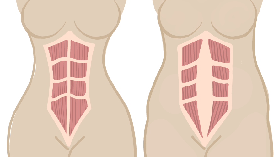 Diastasis Recti before and after, separation of the abdominal muscles after pregnancy