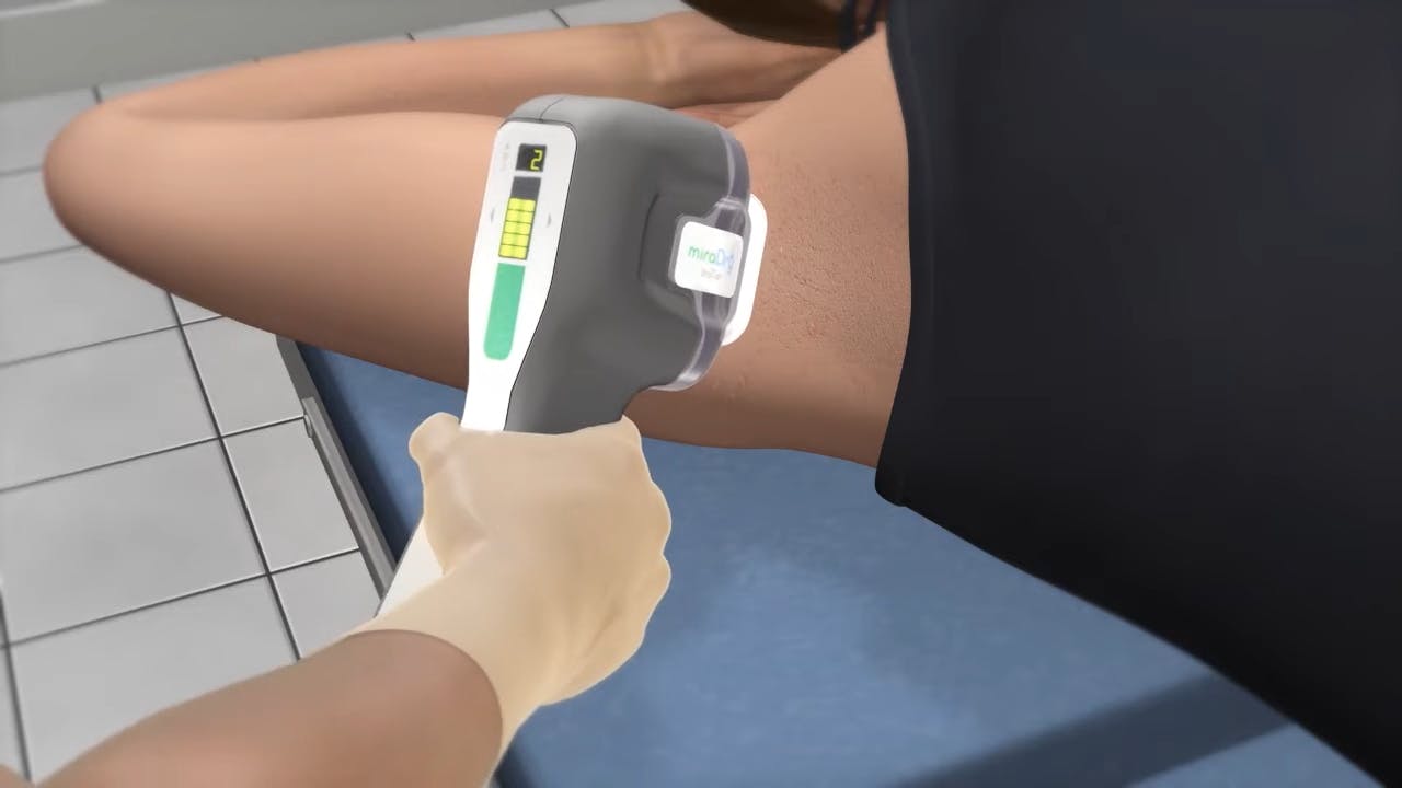 an animated diagram of a miradry treatment