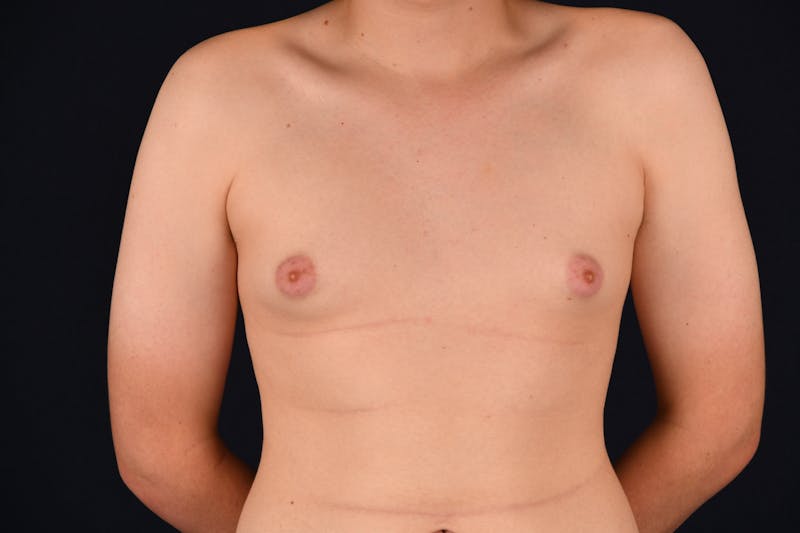 Gynecomastia Before & After Gallery - Patient 26095764 - Image 1