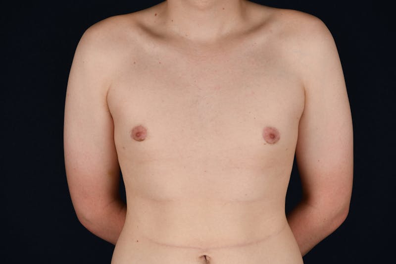 Gynecomastia Before & After Gallery - Patient 26095764 - Image 2
