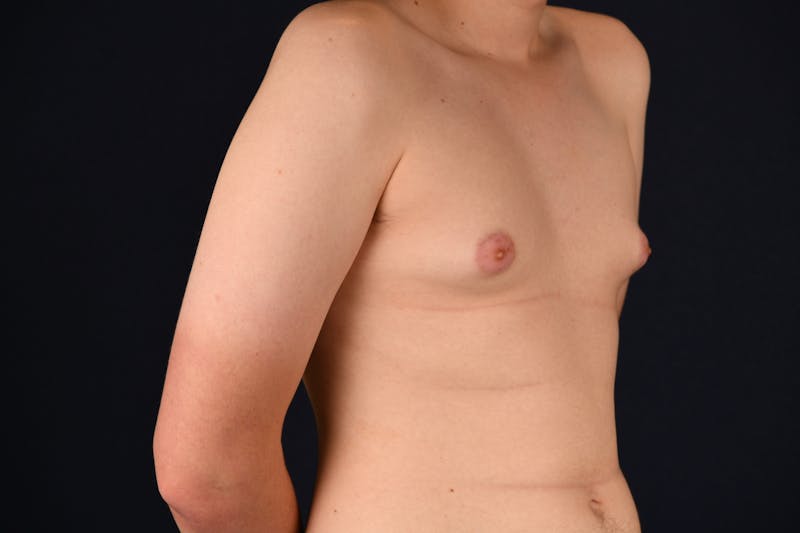 Gynecomastia Before & After Gallery - Patient 26095764 - Image 3