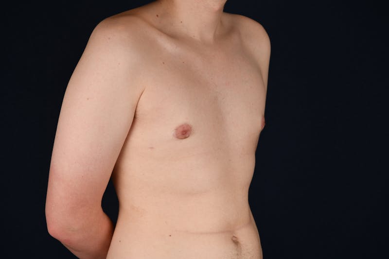 Gynecomastia Before & After Gallery - Patient 26095764 - Image 4