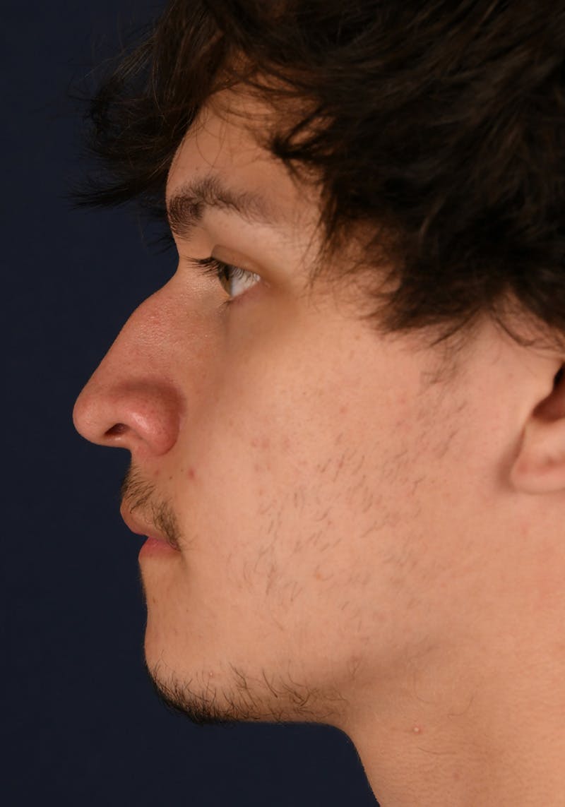 Rhinoplasty Before & After Gallery - Patient 43637644 - Image 5