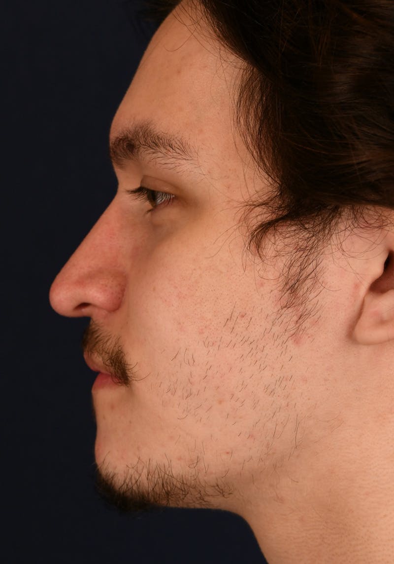 Rhinoplasty Before & After Gallery - Patient 43637644 - Image 6