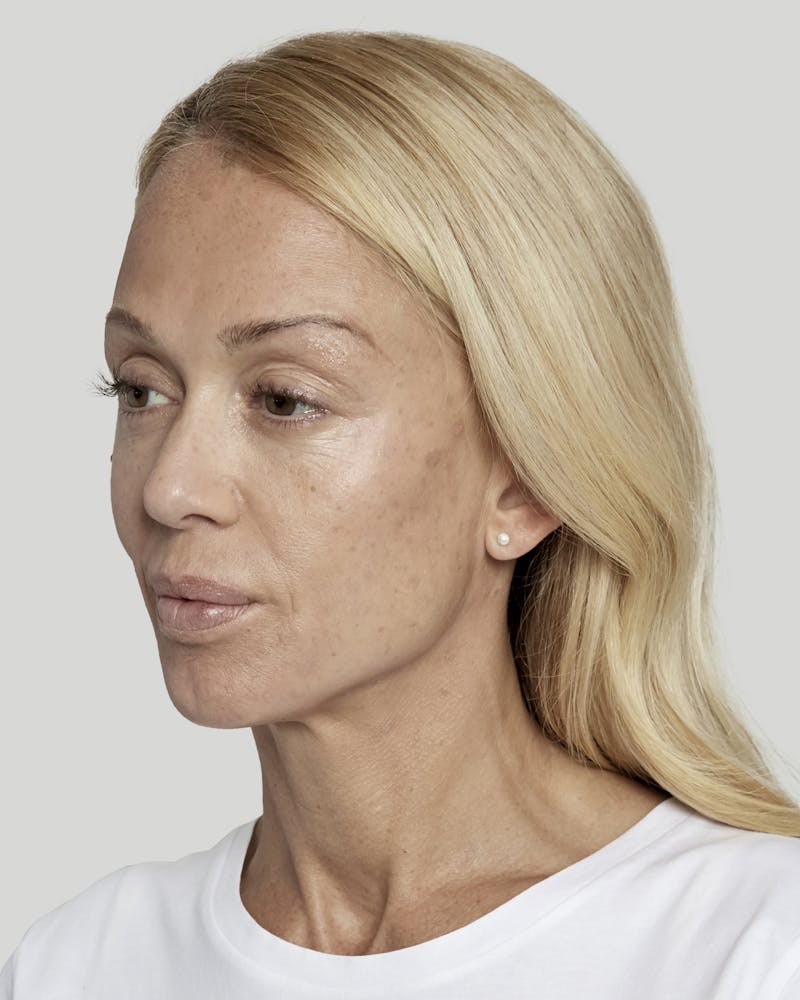 Sculptra Before & After Gallery - Patient 52681088 - Image 6