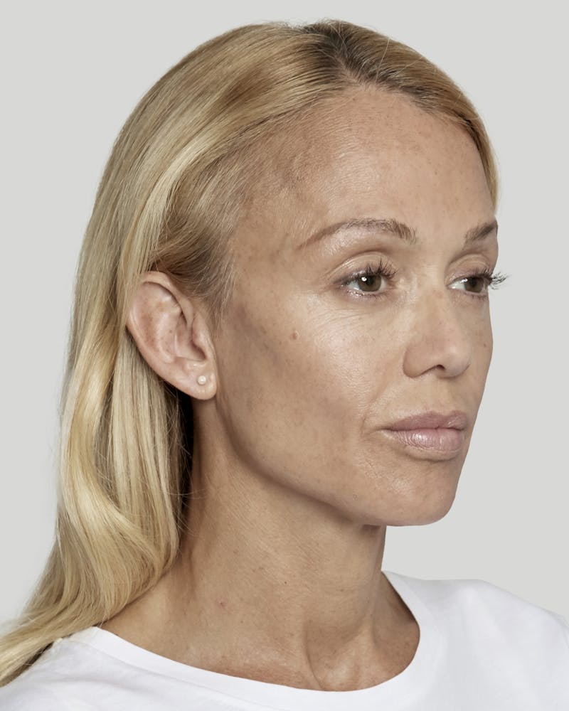 Sculptra Before & After Gallery - Patient 52681088 - Image 4