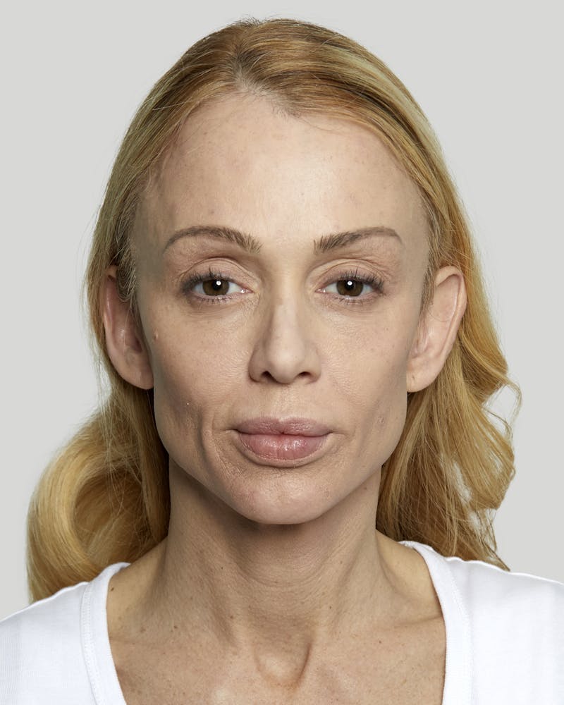 Sculptra Before & After Gallery - Patient 52681088 - Image 1