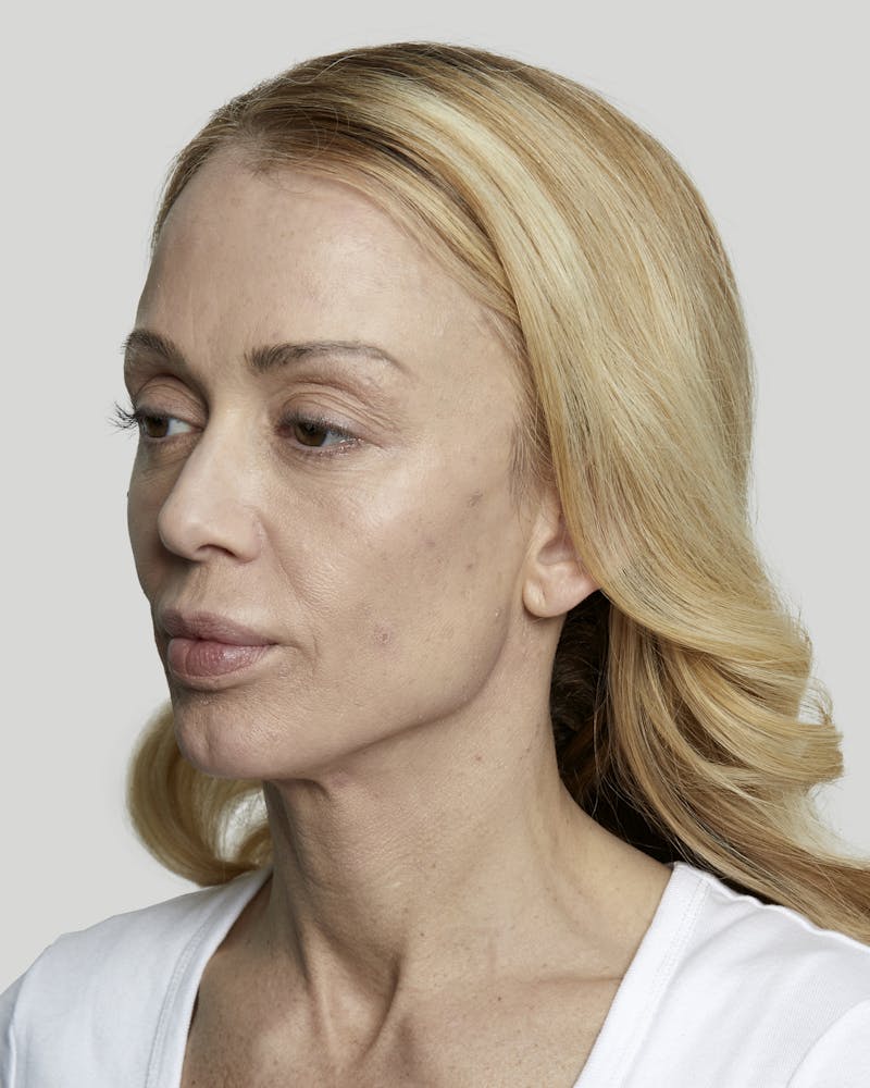 Sculptra Before & After Gallery - Patient 52681088 - Image 5