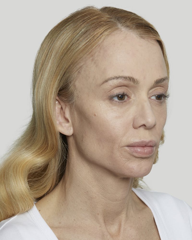 Sculptra Before & After Gallery - Patient 52681088 - Image 3