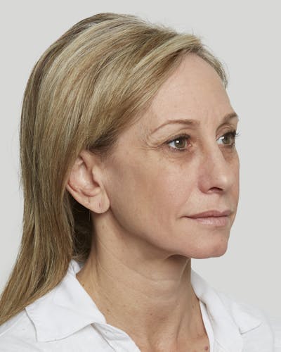 Sculptra Before & After Gallery - Patient 52681089 - Image 3