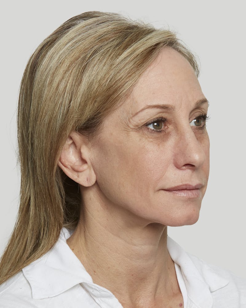 Sculptra Before & After Gallery - Patient 52681089 - Image 3