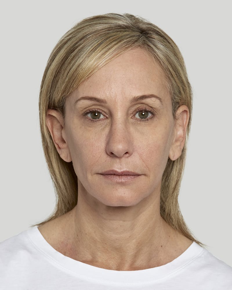 Sculptra Before & After Gallery - Patient 52681089 - Image 2