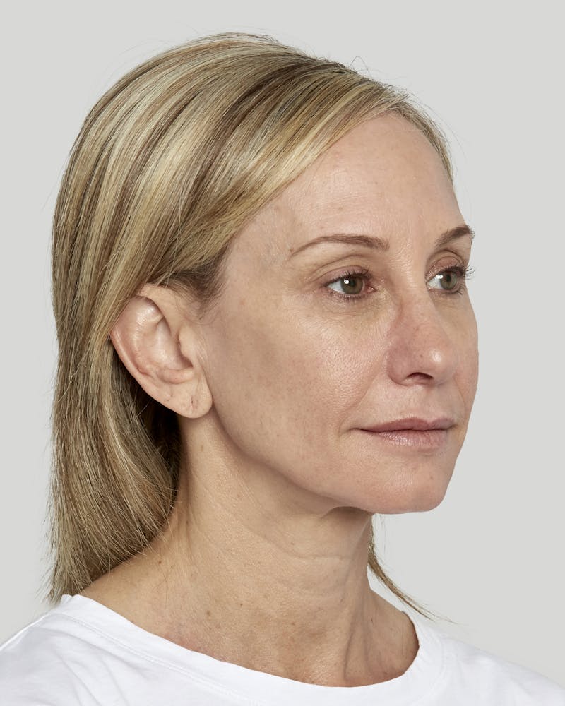 Sculptra Before & After Gallery - Patient 52681089 - Image 4
