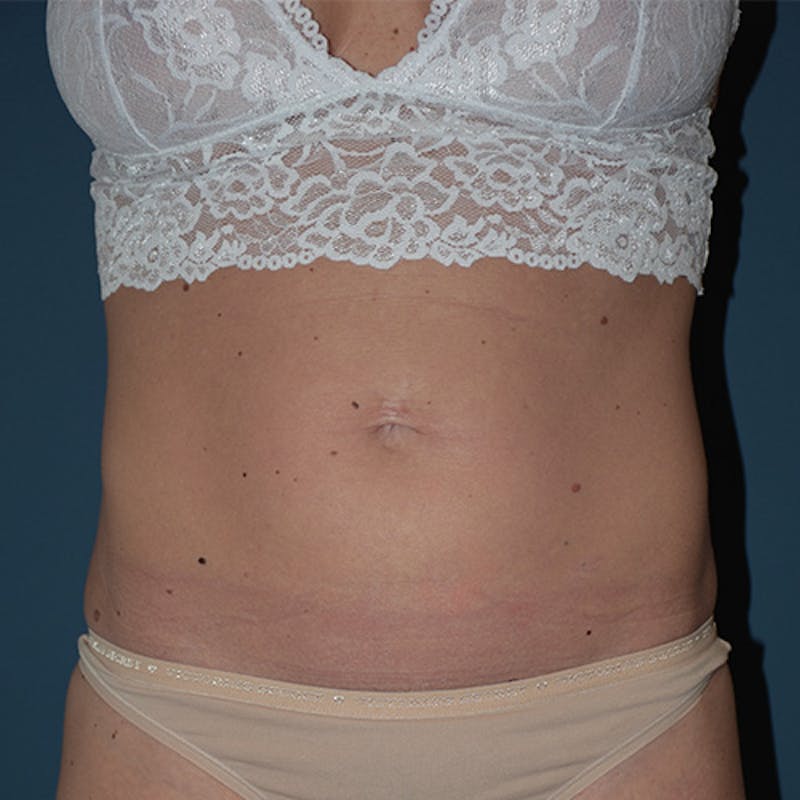Coolsculpting Before & After Gallery - Patient 109314529 - Image 1