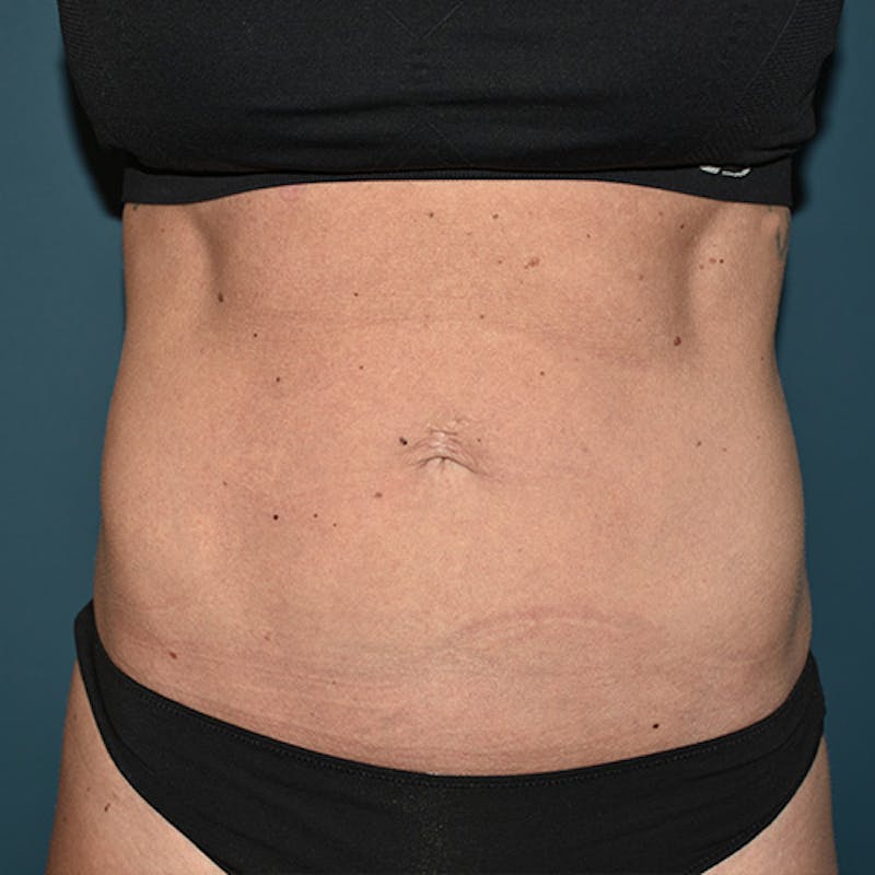 Coolsculpting Before & After Gallery - Patient 109314529 - Image 2