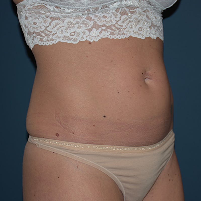 Coolsculpting Before & After Gallery - Patient 109314529 - Image 3