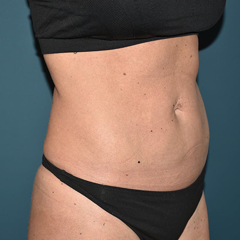 Coolsculpting Before & After Gallery - Patient 109314529 - Image 4