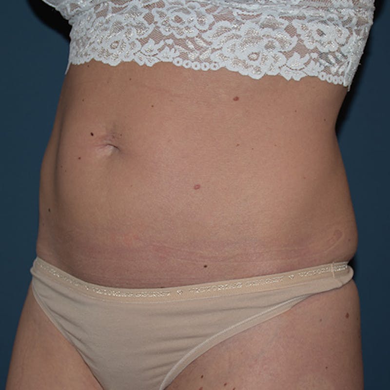 Coolsculpting Before & After Gallery - Patient 109314529 - Image 5