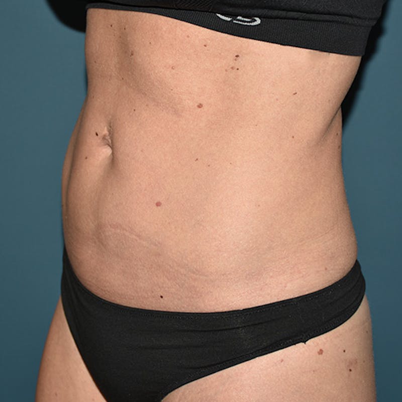 Coolsculpting Before & After Gallery - Patient 109314529 - Image 6