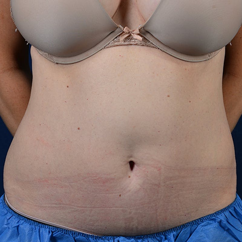Coolsculpting Before & After Gallery - Patient 109314528 - Image 1