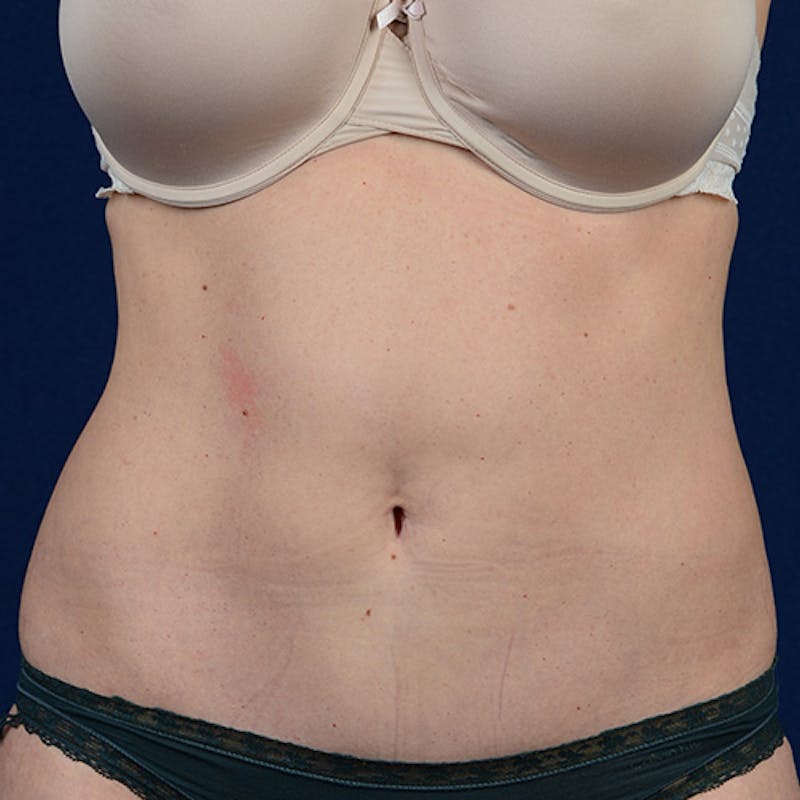 Coolsculpting Before & After Gallery - Patient 109314528 - Image 2