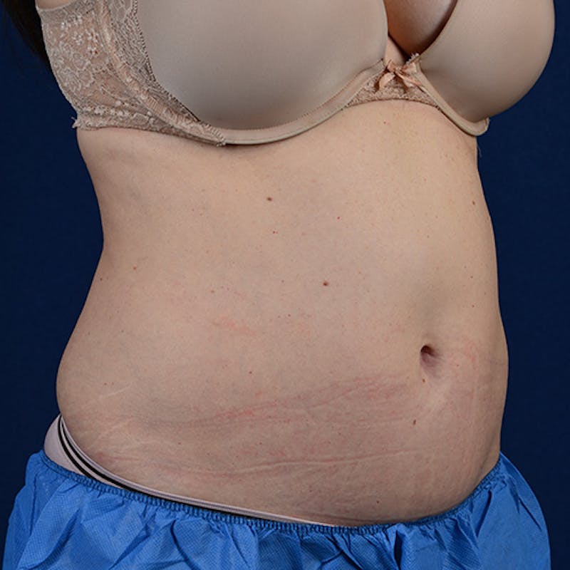 Coolsculpting Before & After Gallery - Patient 109314528 - Image 5