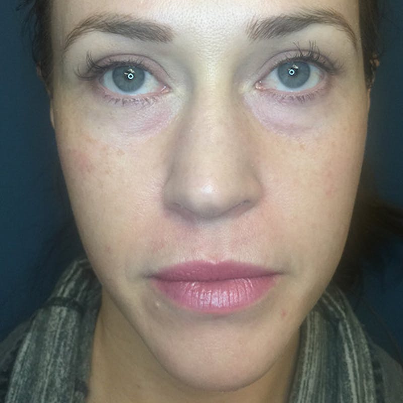 Facial Fillers Before & After Gallery - Patient 109314540 - Image 1