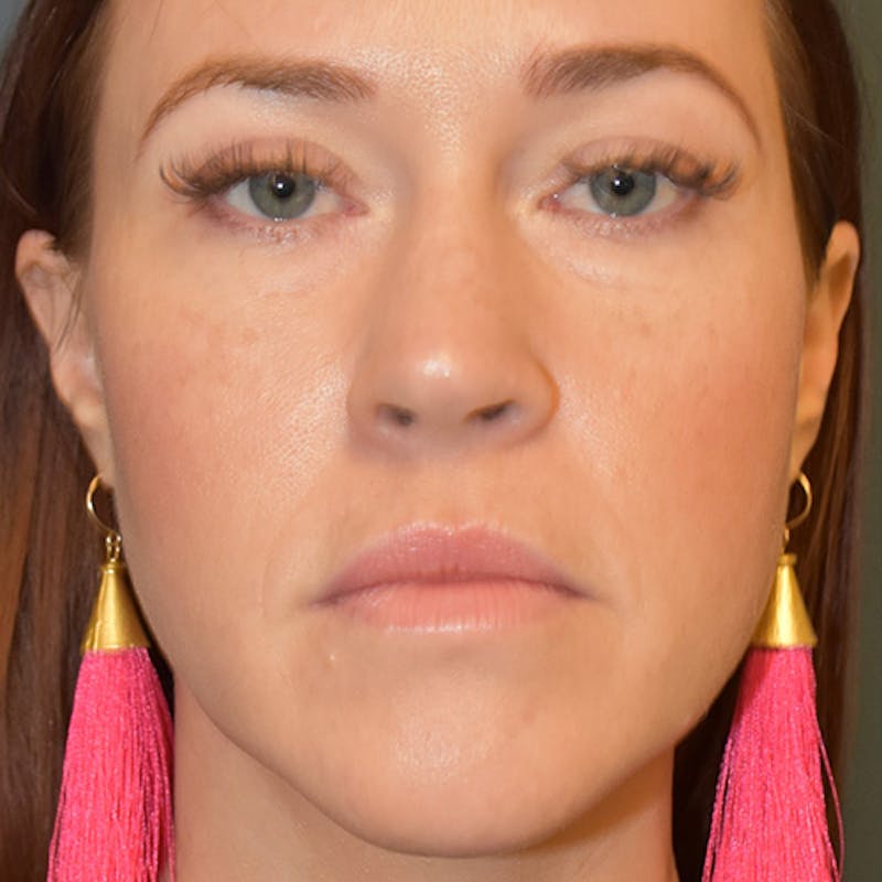 Facial Fillers Before & After Gallery - Patient 109314540 - Image 2