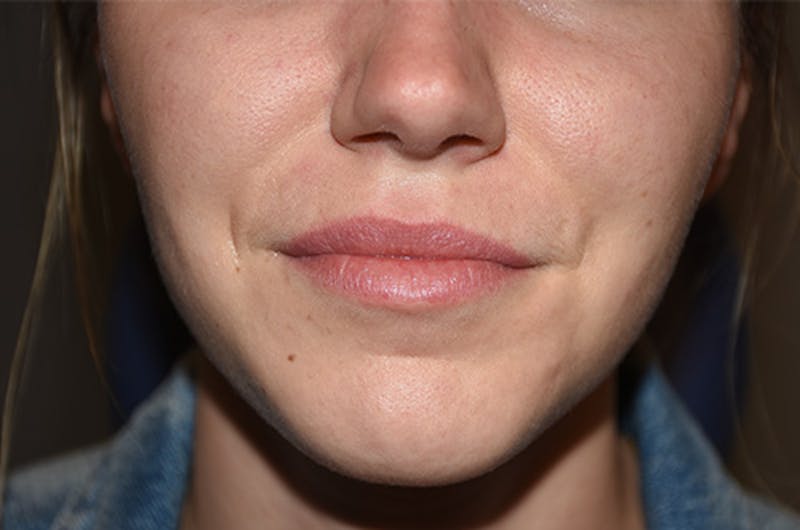 Facial Fillers Before & After Gallery - Patient 109314542 - Image 1