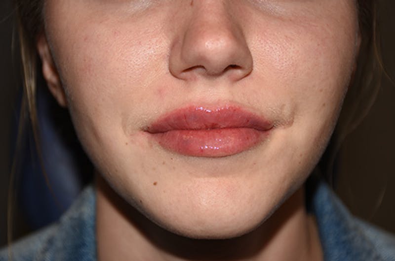 Facial Fillers Before & After Gallery - Patient 109314542 - Image 2