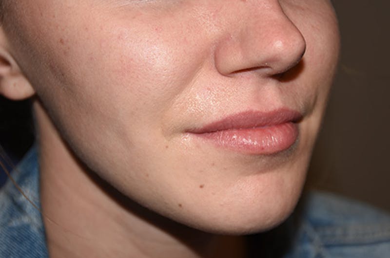 Facial Fillers Before & After Gallery - Patient 109314542 - Image 3