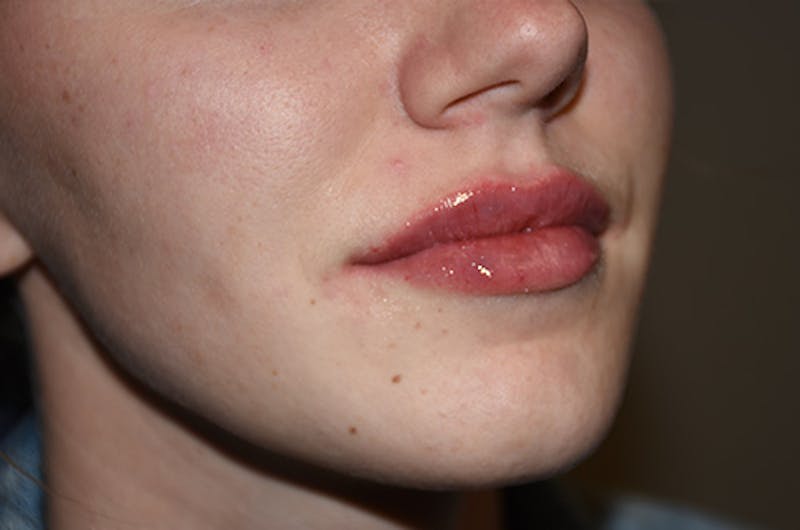 Facial Fillers Before & After Gallery - Patient 109314542 - Image 4