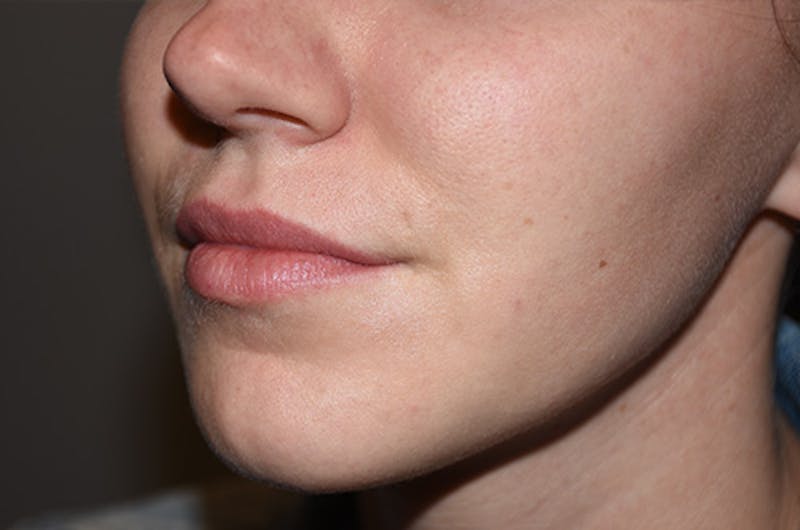 Facial Fillers Before & After Gallery - Patient 109314542 - Image 5